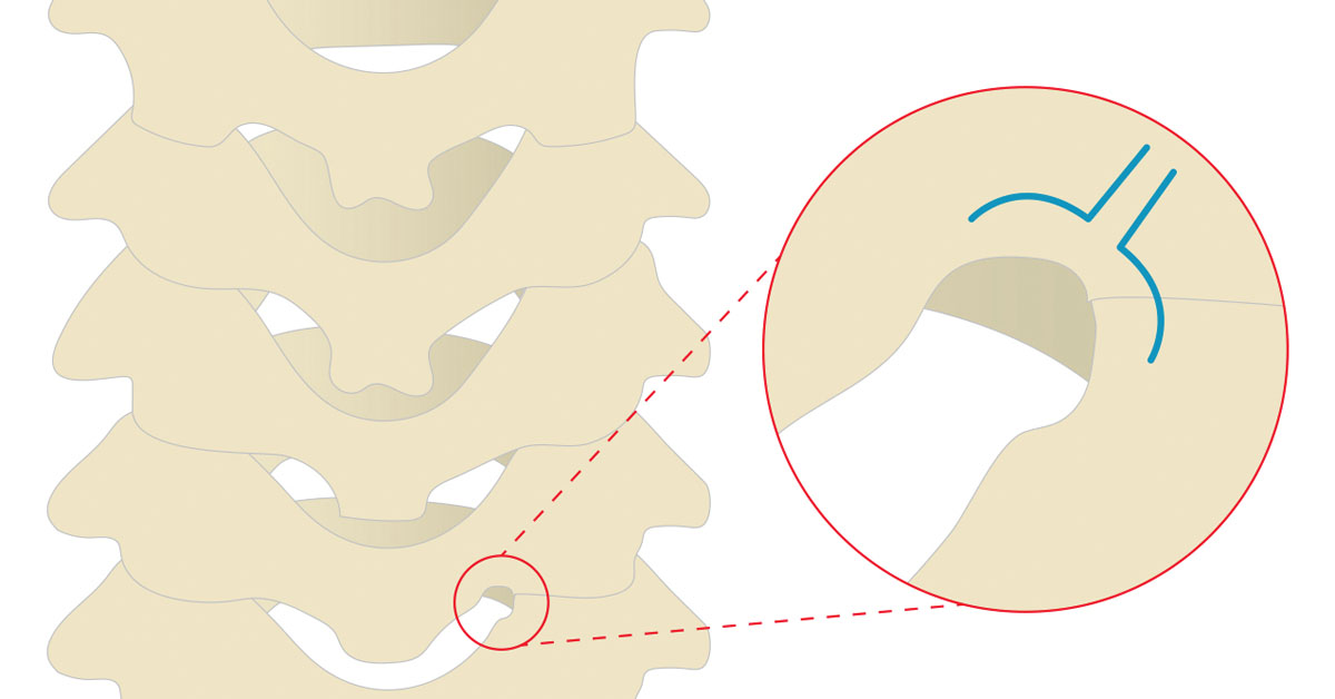 Cervical Foraminotomy