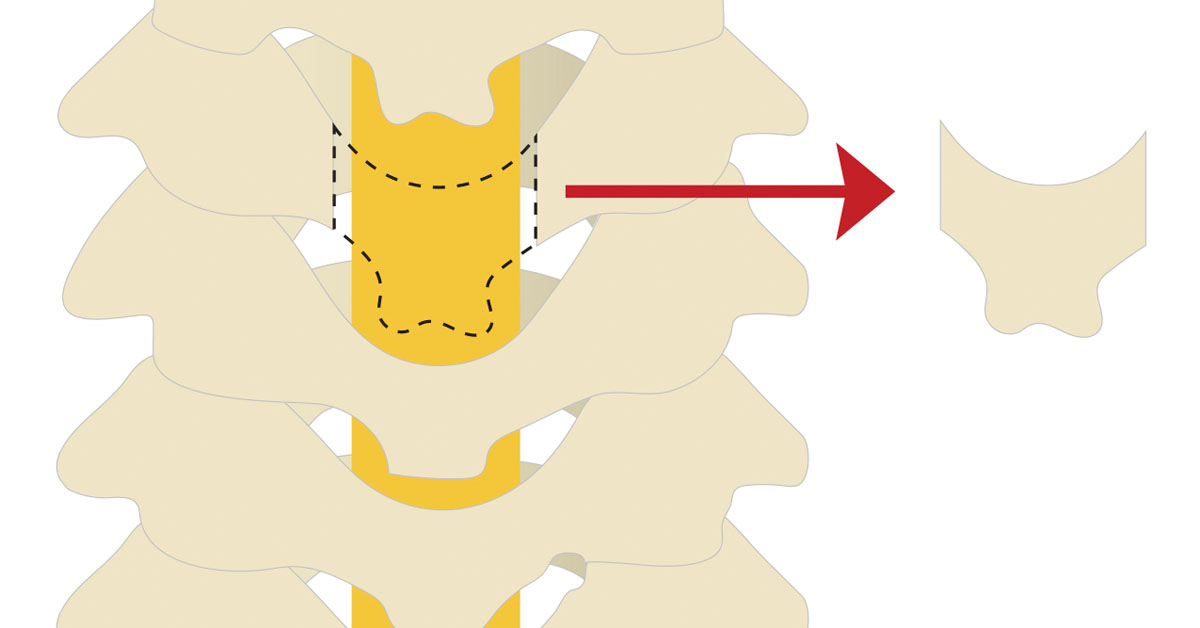 Cervical Laminectomy