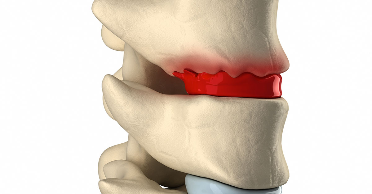 Degenerative Disc Disease