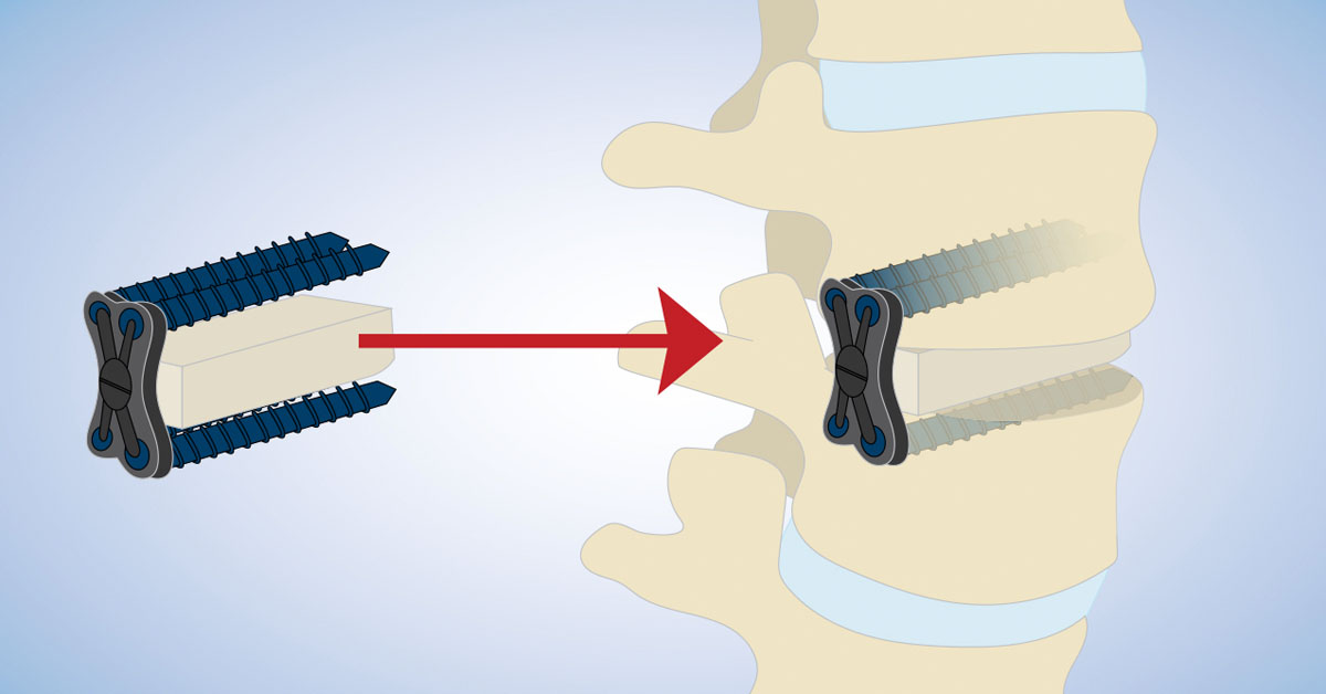 Direct Lateral Interbody Fusion