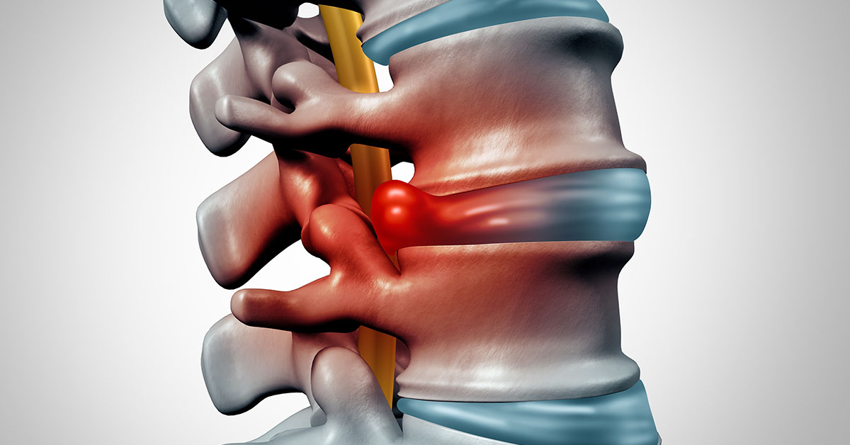 Herniated Disc