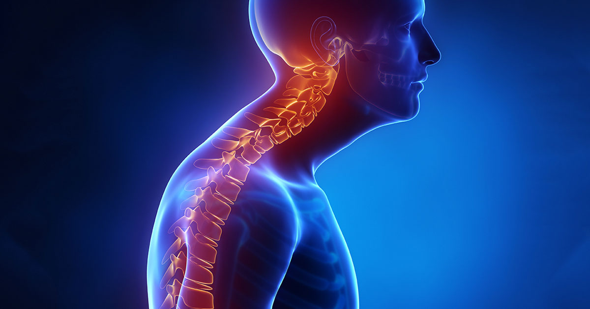 Kyphosis