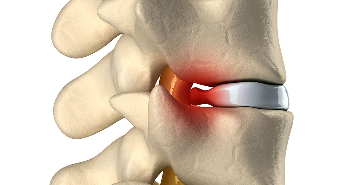Radiculopathy