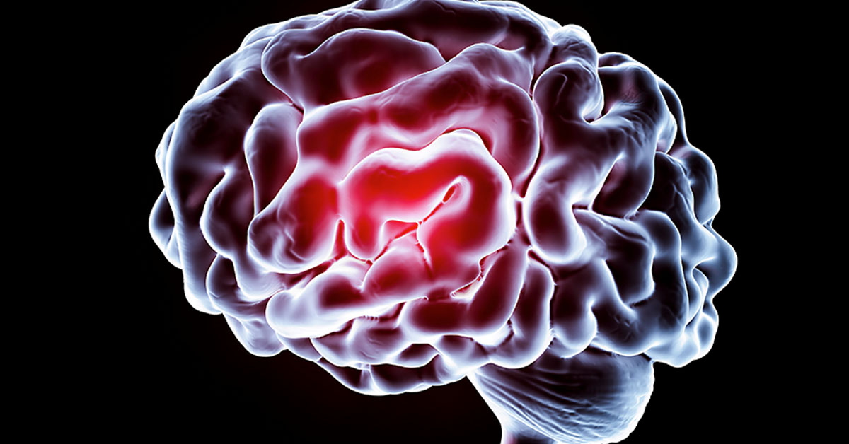 Subarachnoid Hemorrhage