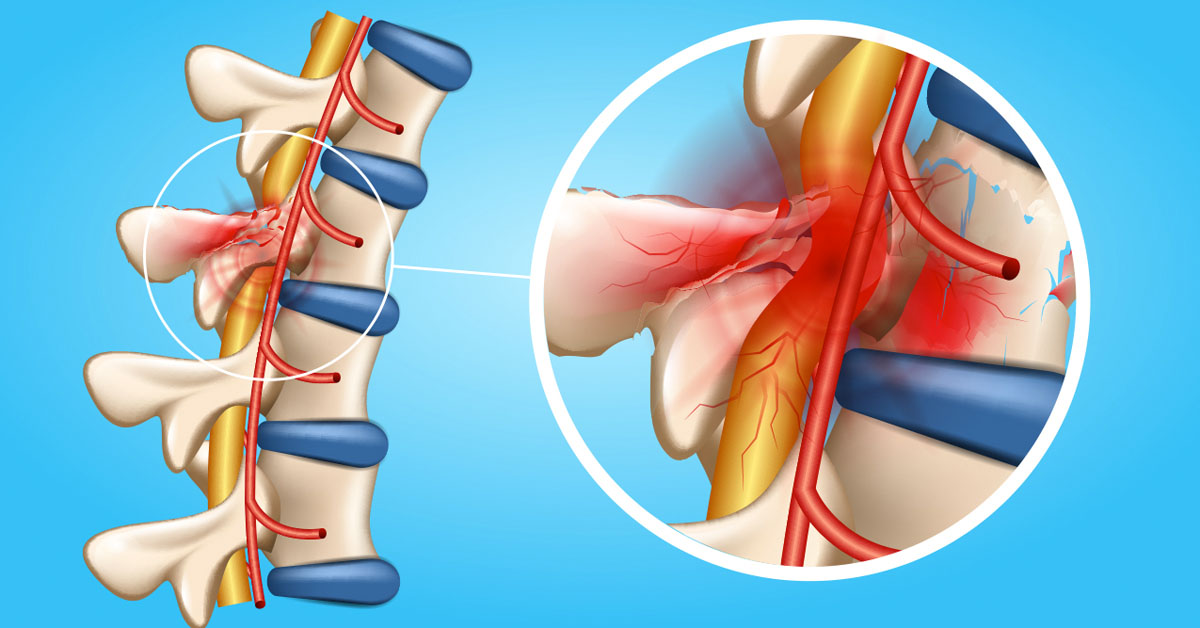 Myelopathy
