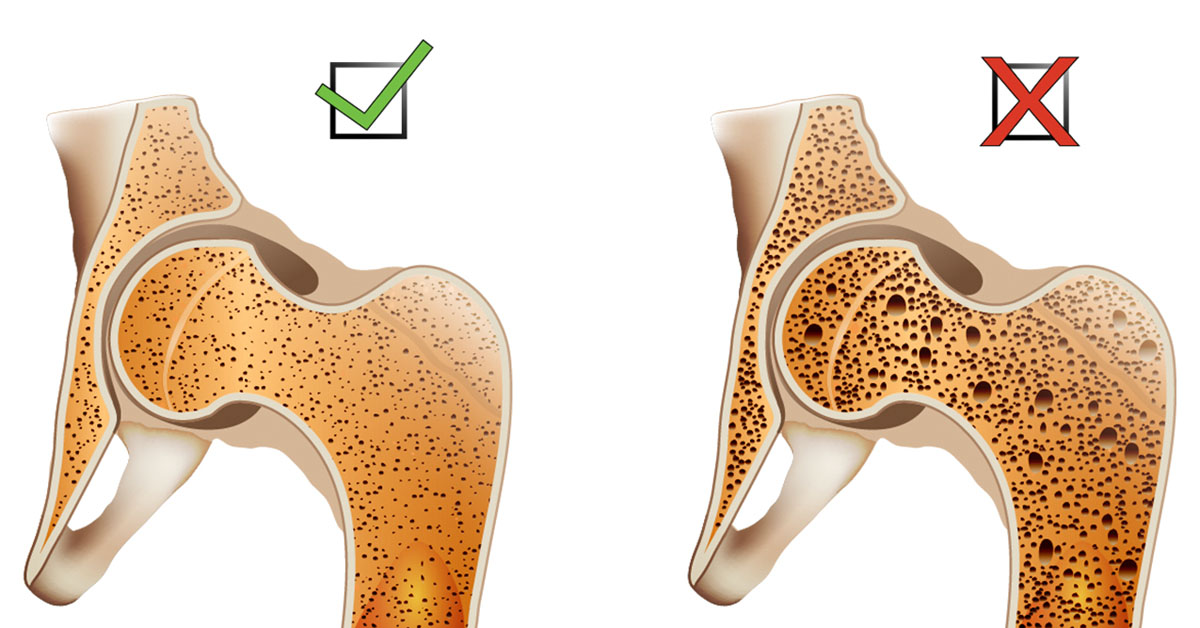 Osteoporosis
