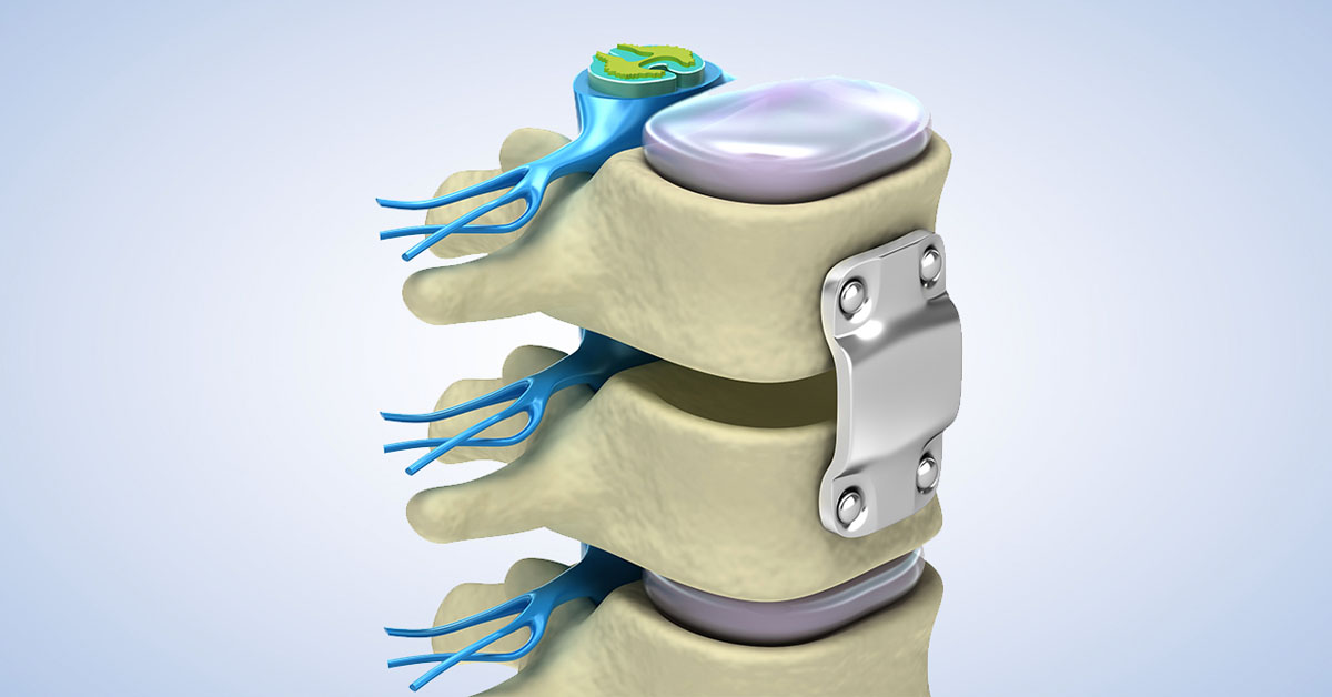 Extreme Lateral Interbody Fusion XLIF